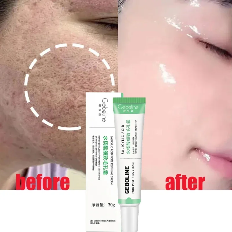 Krim Kecilkan pori asam salisi - Skincare Salicylic Acid ulasan dan harga