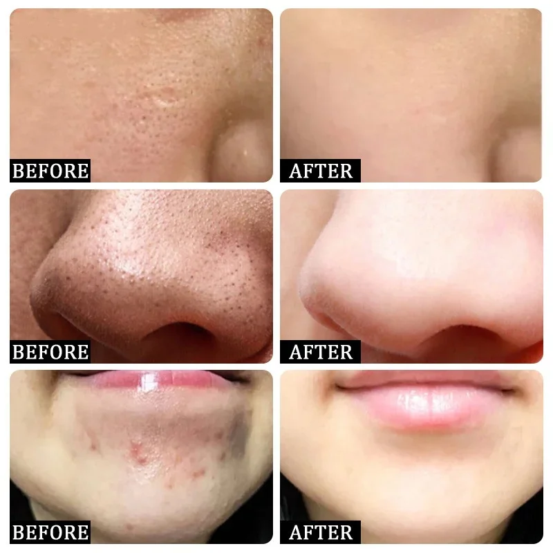 Krim Pembersih Pori Asam Salis - Skincare Salicylic Acid ulasan dan harga